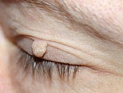 220px-Weiches-fibrom-augenlid