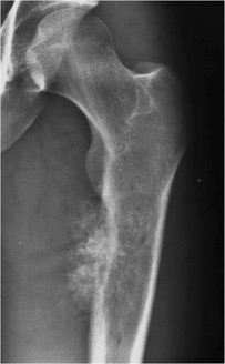 652a-mesenchymal-chondrosarcoma-1-x-ray-sarcoma-images