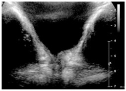 hematurie1