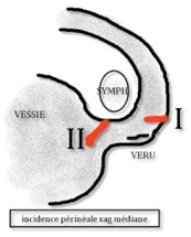 hematurie3