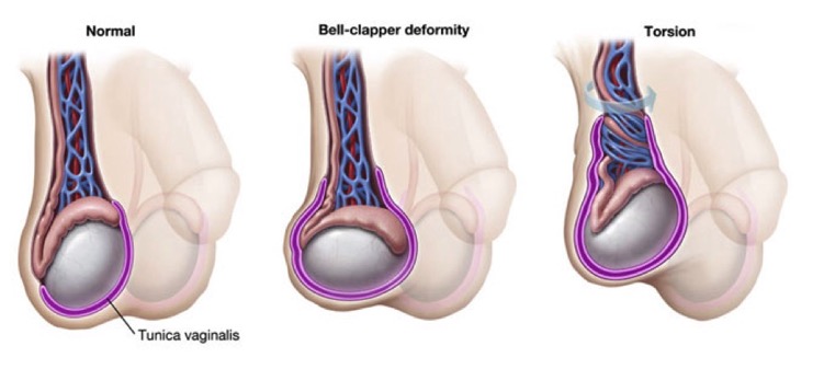 torsion testicule