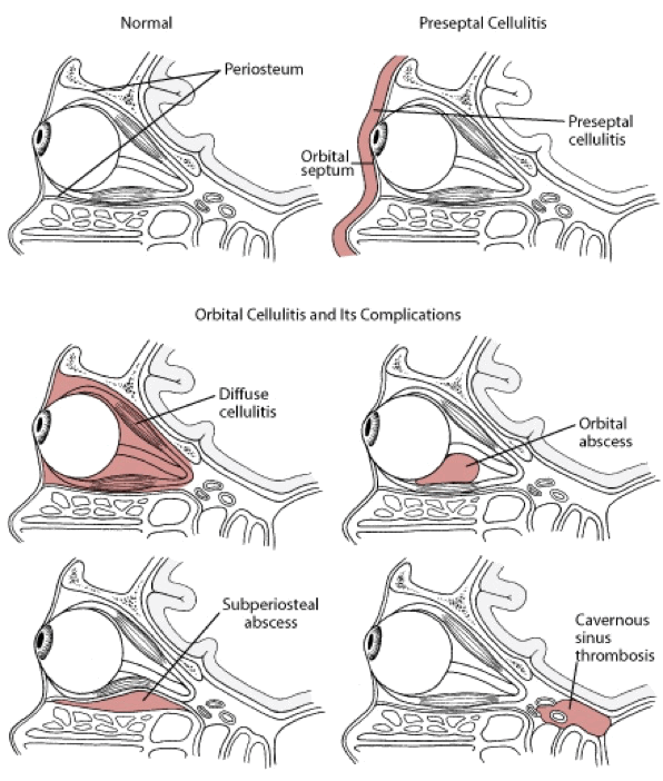 EYE_orbital_cellulitis_and_its_complications_current