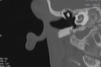 37750782_1_Rochers 1,00 Hr64 S1 Os Droit cor_38