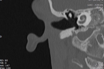 37750782_1_Rochers  1,00  Hr64  S1  Os Droit  cor_38