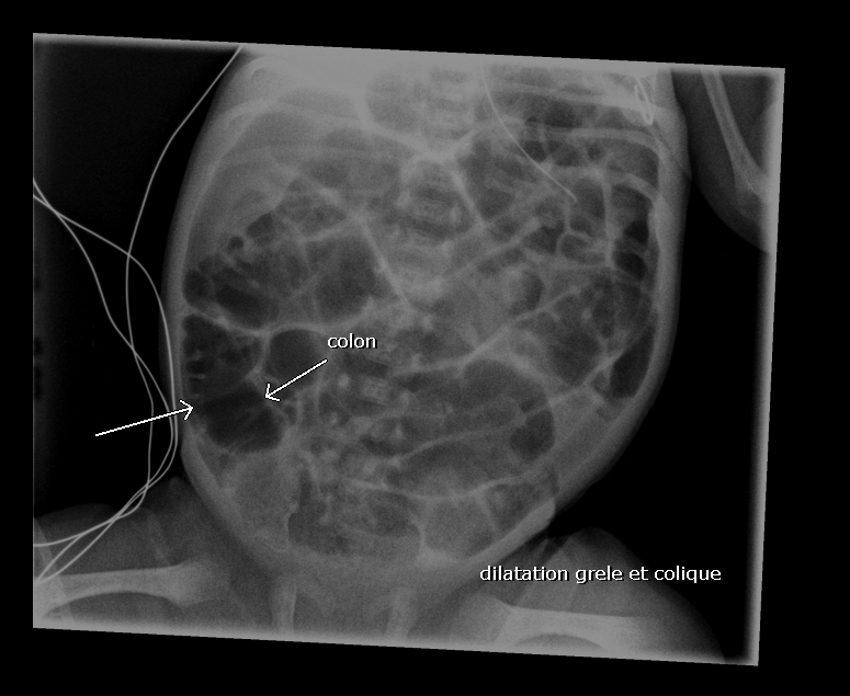 dilat grele et colique hirschprung ou fct car prema donc procub si air rectum fct