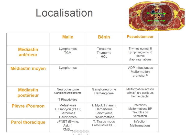 masse pulmonaire