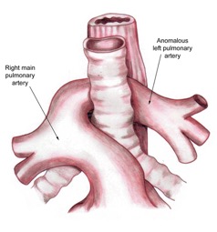 Aberrant left pulmonary artery or pulmonary artery sling