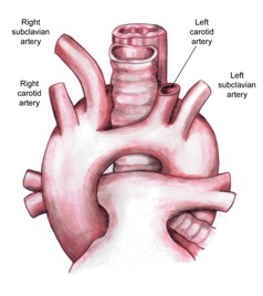 Double aortic arch