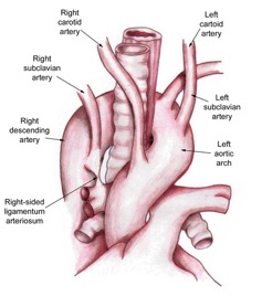 Left aortic arch with right descending aorta and right ligamentum arteriosum