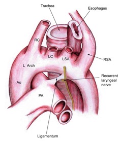 Retroesophageal right subclavian artery with left aortic arch and left ligamentum arteriosum