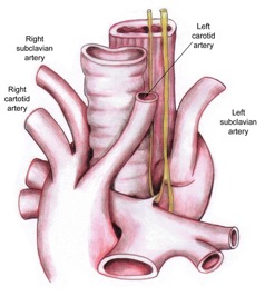 Right aortic arch with aberrant left subclavian artery and left ligamentum arteriosum