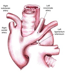 Right aortic arch with mirror-image branching and retroesophageal ligamentum arteriosum