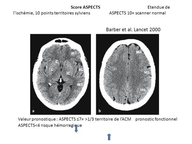 Score+ASPECTS.+Etendue+de+l’ischémie,+10+points+territoires+sylviens