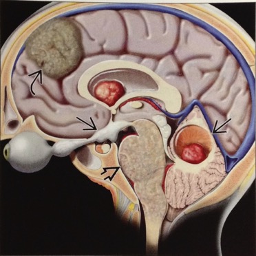 Astrocytoma