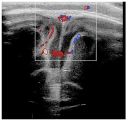 meningite1