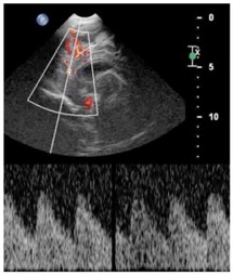 meningite2