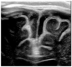 meningite3