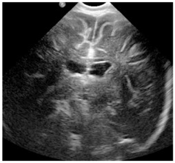 meningite4