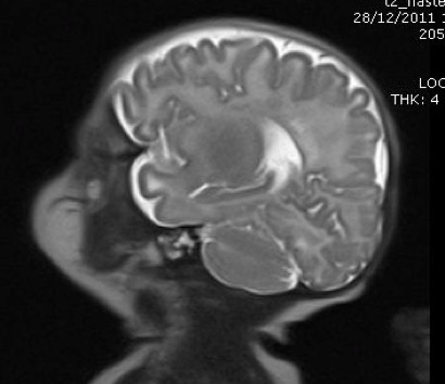 leucomalacie2_result