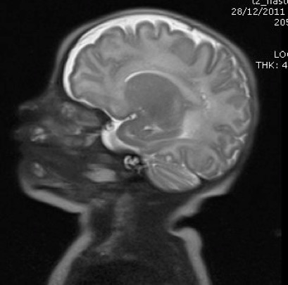 leucomalacie_result