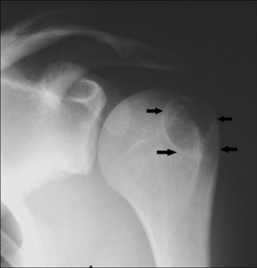 chrondroblastoma_cbl_joyce_high_fr