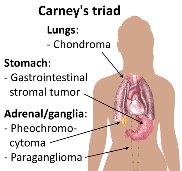 Carney's_triad