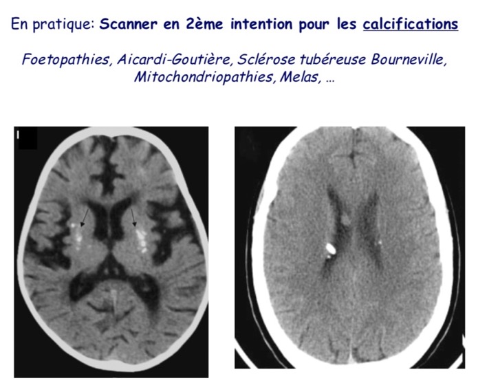 calcifications SNC