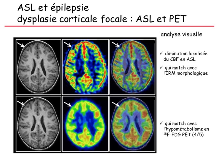 ASL et épilepsie