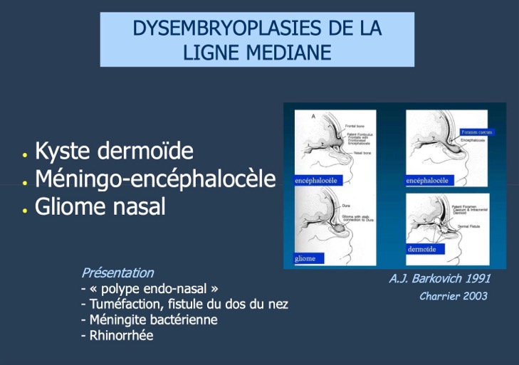 DYSEMBRYOPLASIES DE LA LIGNE MEDIANE