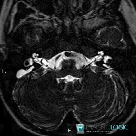 dilatation-l-aqueduc-vestibule-os-temporal-oreille-interne-irm-2787-2d4bec821d00bfd-478