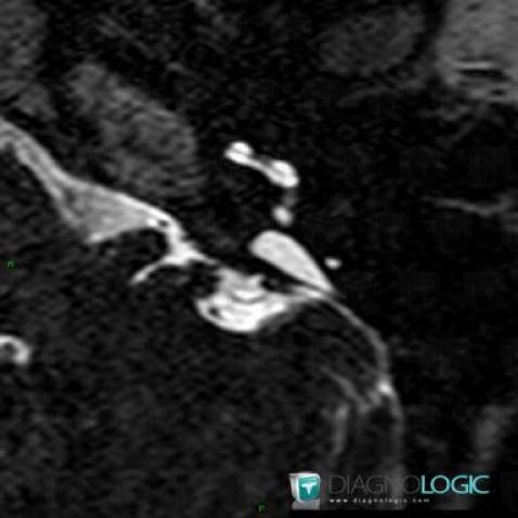 dilatation-l-aqueduc-vestibule-os-temporal-oreille-interne-irm-2789-18f01b3fa19b251-478
