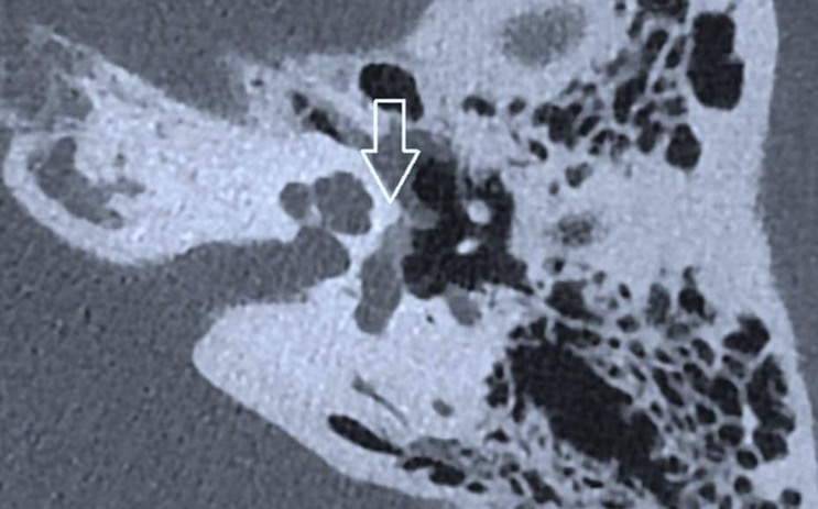 Scanner du rocher gauche en vue oblique montrant un foyer d’otospongiose sous la forme d’une hypodensité de l’os temporal (flèche blanche) interposée entre la cochlée et le vestibule