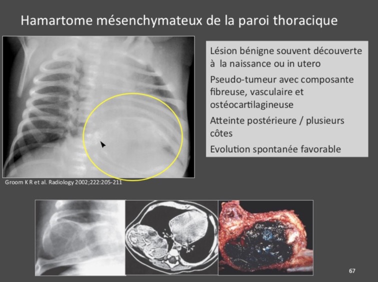 Hamartome mésenchymateux de la paroi thoracique