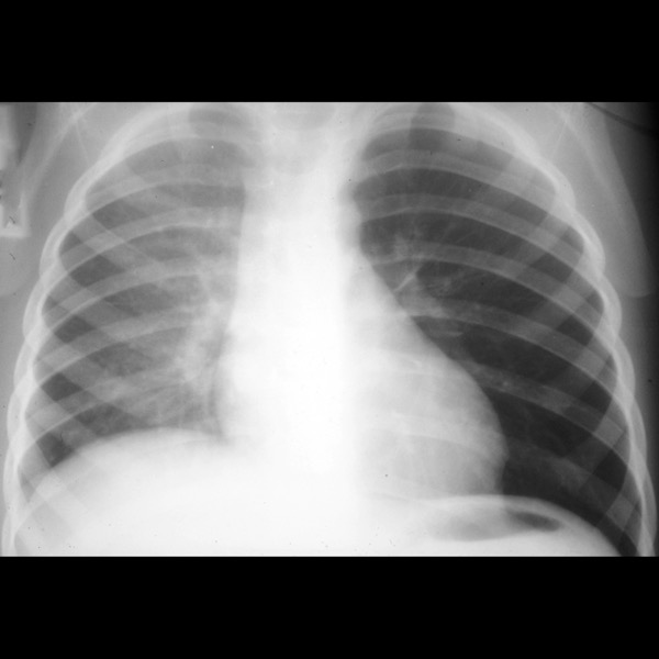 airwayforeignbody16jakleftcxr3yo