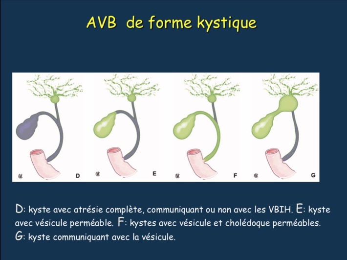 AVB1