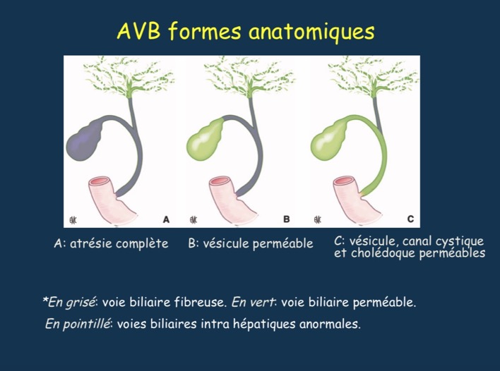 AVB2