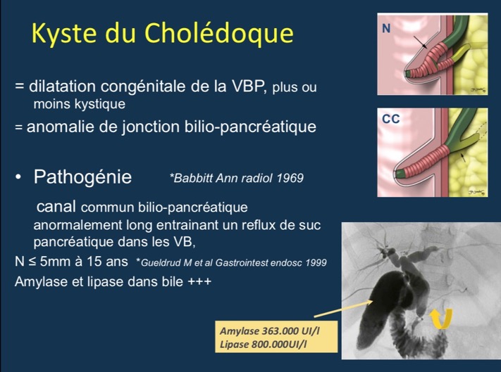 Kyste du Cholédoque