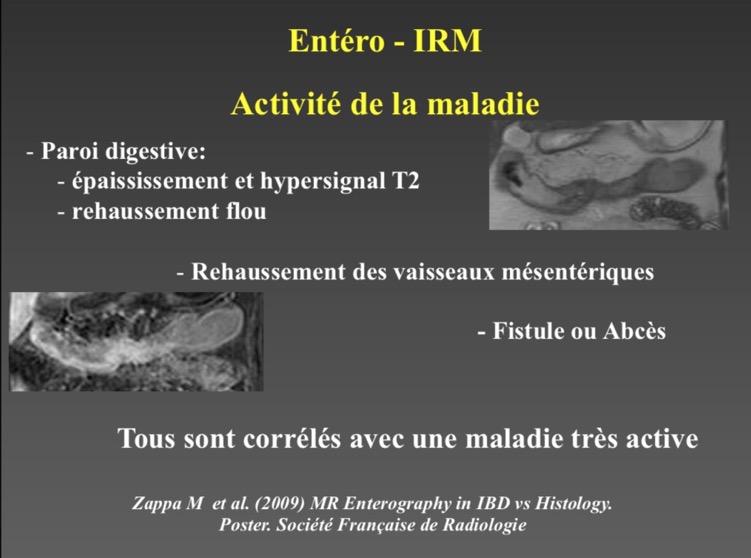 Entero-IRM Activité de la maladie