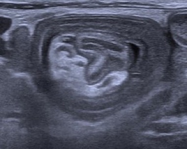 Invagination_Sonografie