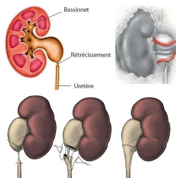 jonction-pyelo-ureterale-1