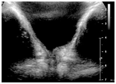 hematurie1