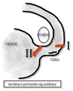 hematurie3