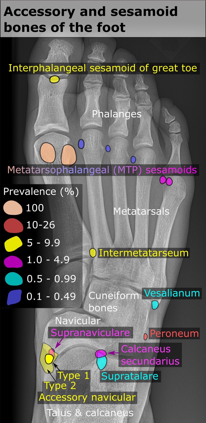 Accessory_and_sesamoid_bones_of_the_foot_-_dorsoplantar_projection
