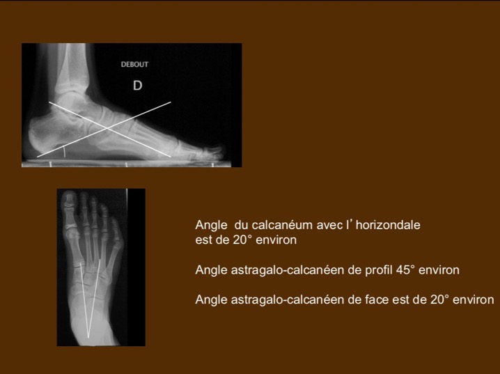Angles pied bot