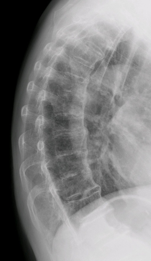 forestier0027s_disease002c_x-ray_of_thoracic_column