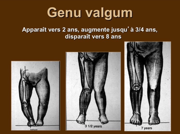 Genu valgum