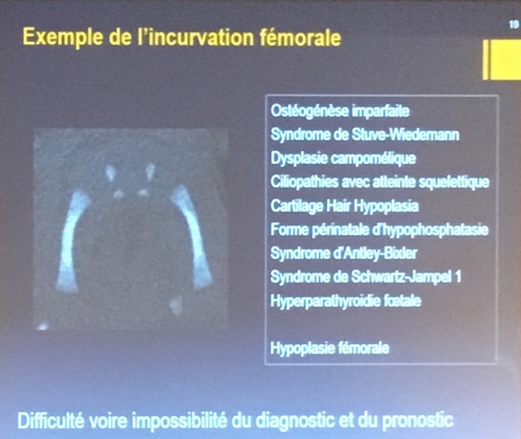 incurvation fémorale
