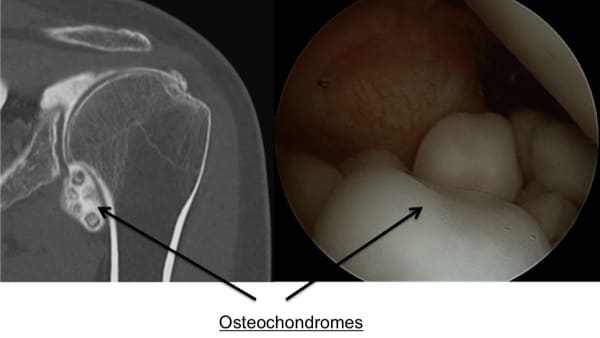 osteochondromatose-epaule-osteochondromatose-traitement-epaule-chirurgien-orthopedique-paris-chirurgien-epaule-chirurgien-coude