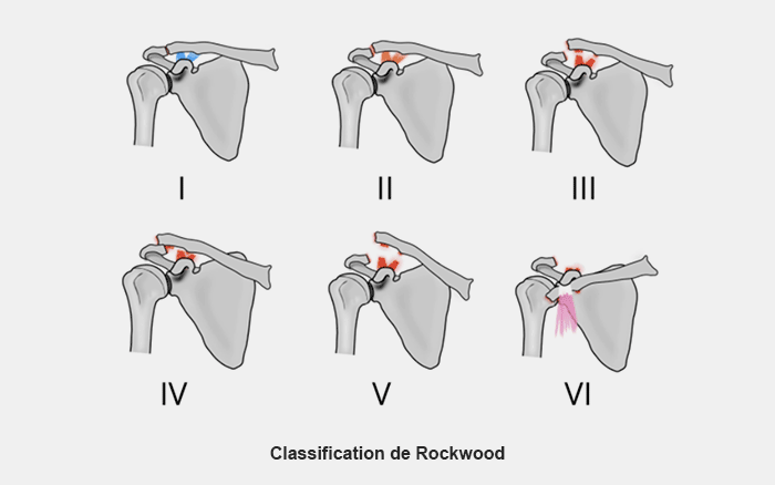 classification-de-rockwood