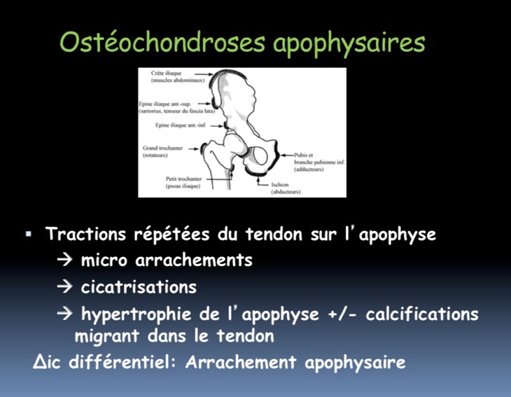 Ostéochondroses apophysaires bassin